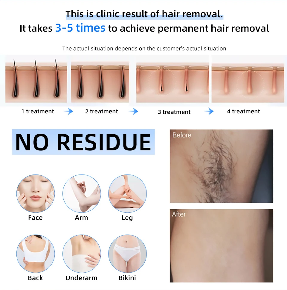 High Power Diode Laser Hair Removal Machine 808nm Wavelength Painless Permanent Epilator for Women Spa Laser Salon