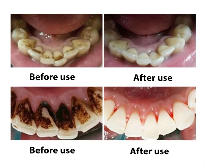 multifuncional dental foice tártaro scaler dentes escolher