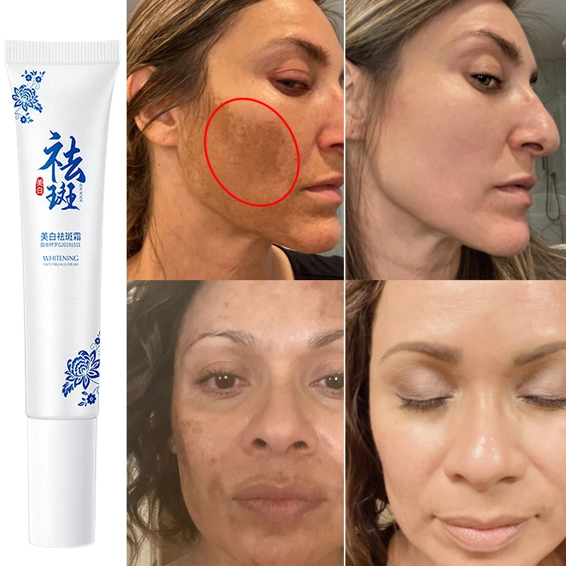 Face Skin Care Freckles Cream Remove Melasma Dark Spot Lightening
