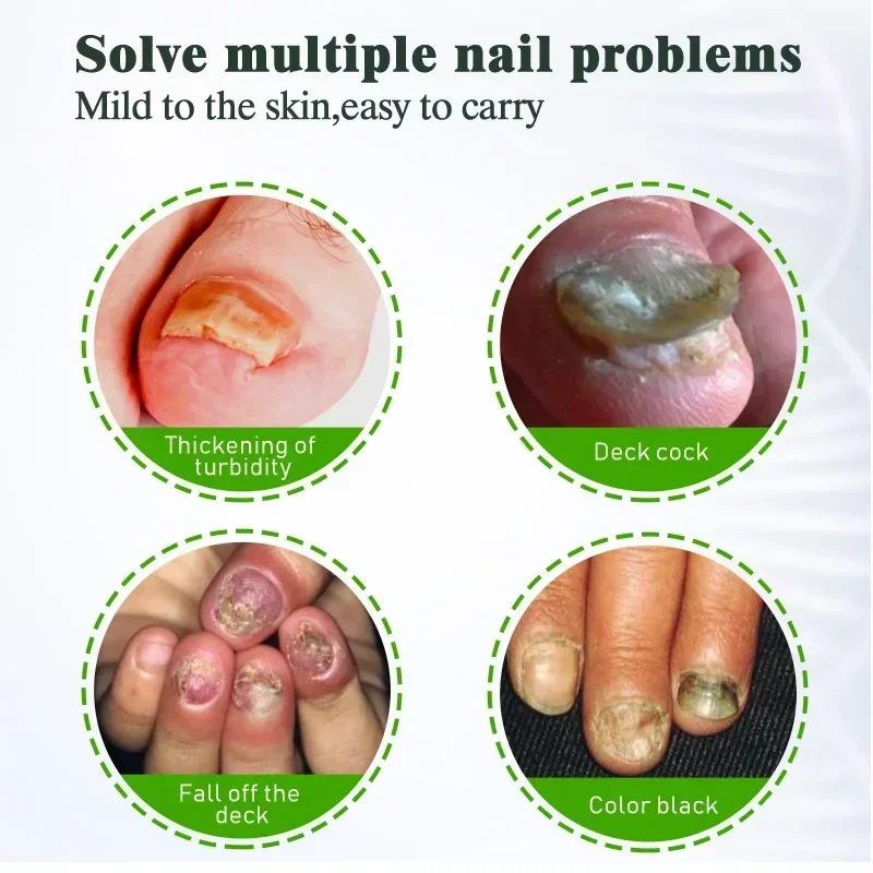 Nail Fungus Treatment Cream Onychomycosis Paronychia Anti Fungal Nail Infection Fights Bacteria and Fungus Naturally Oint U&ntilde;as nail fungus remover