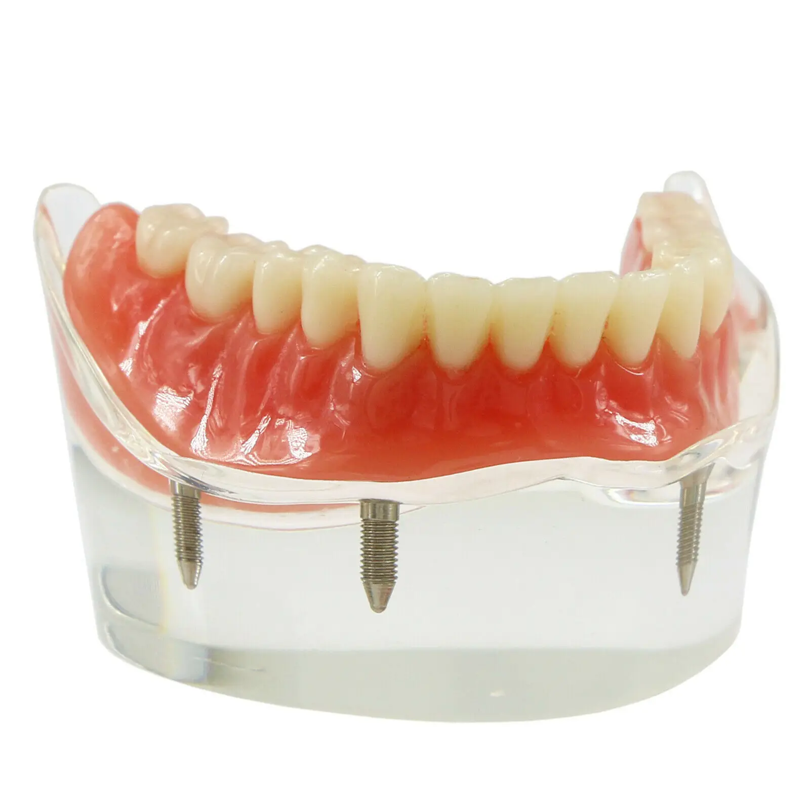 NEW Dental Implant Tooths Model Overdenture Inferior with 4 Implants Demo #6003