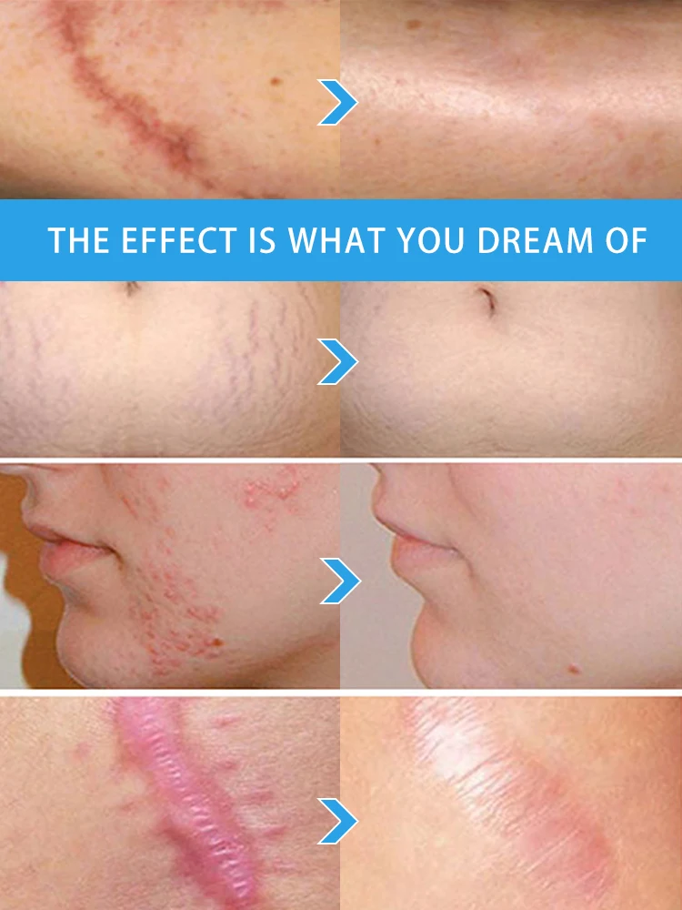 

Cream To Remove Scars Surgery Scar Removal Cream Scar Repair To Prevent Scars