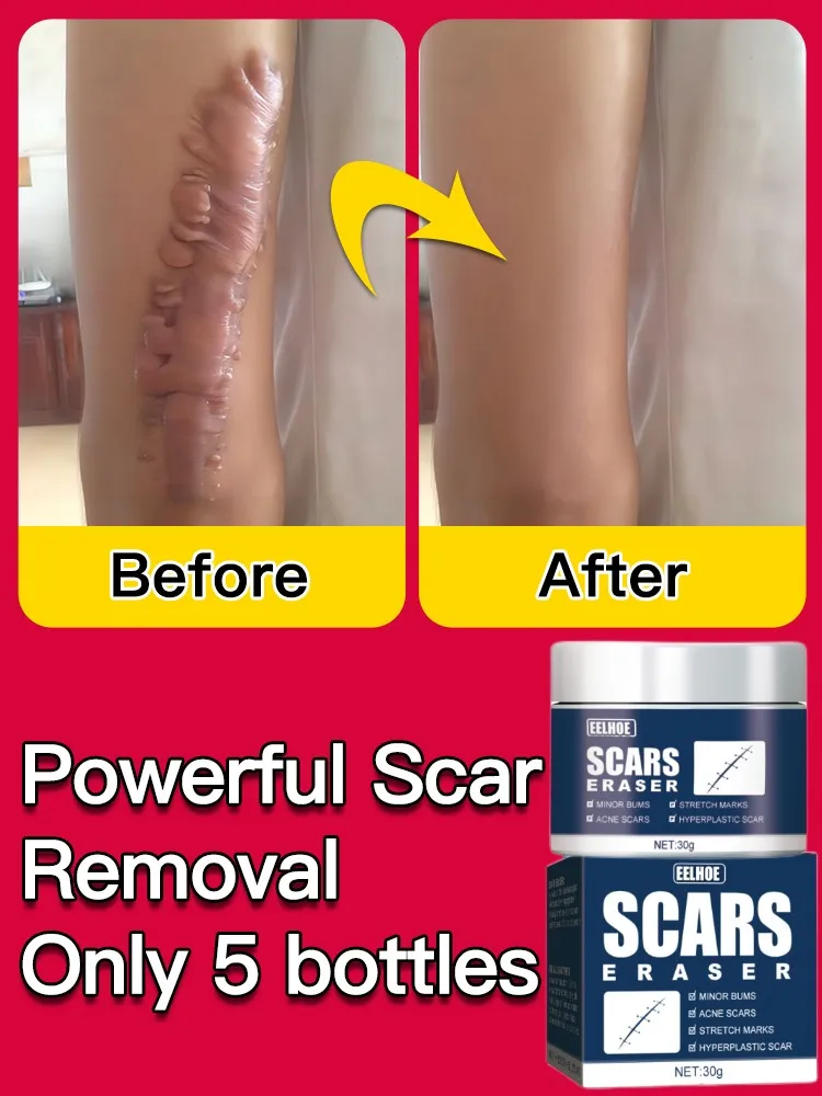 

New Rapid Scar Removal Cream Effective Treatment Stretch Marks Burns Lighten Acne Spots Section Scars Whiten Skin Care Products