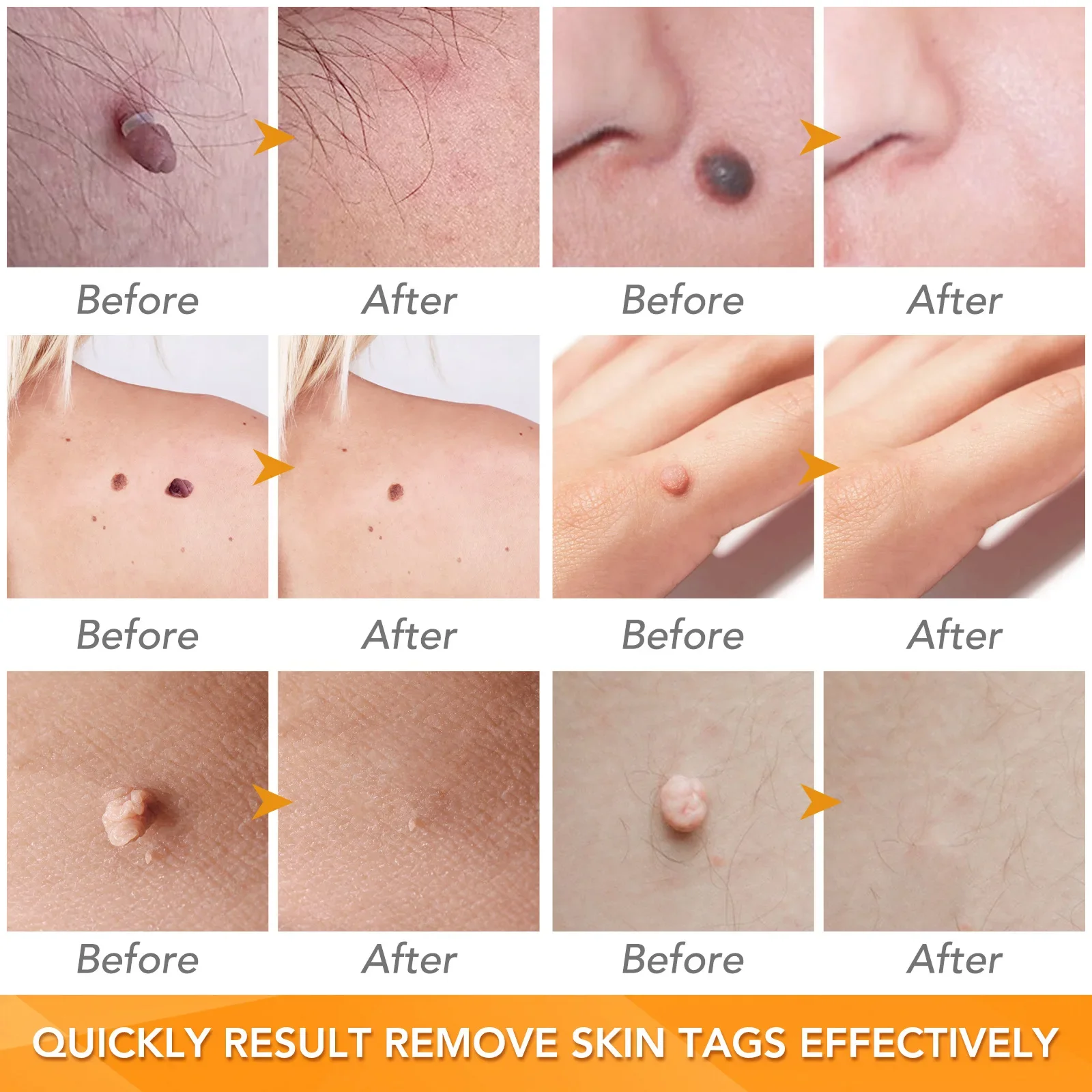 Simple Wart Removal Tool Set Skin Tag Removeal Tool Easy To Clean Skin Care Tag Removal Care Products skin tag removal tool