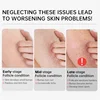 Keratosis Pilaris Cream – Smooth, Clear & Soft Skin