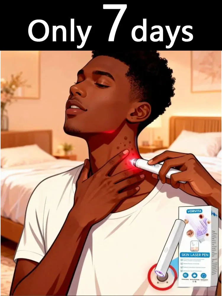 2026년 신형 3세대 업그레이드된 사마귀 치료제, F??? ?c???g ?? ?????? ..