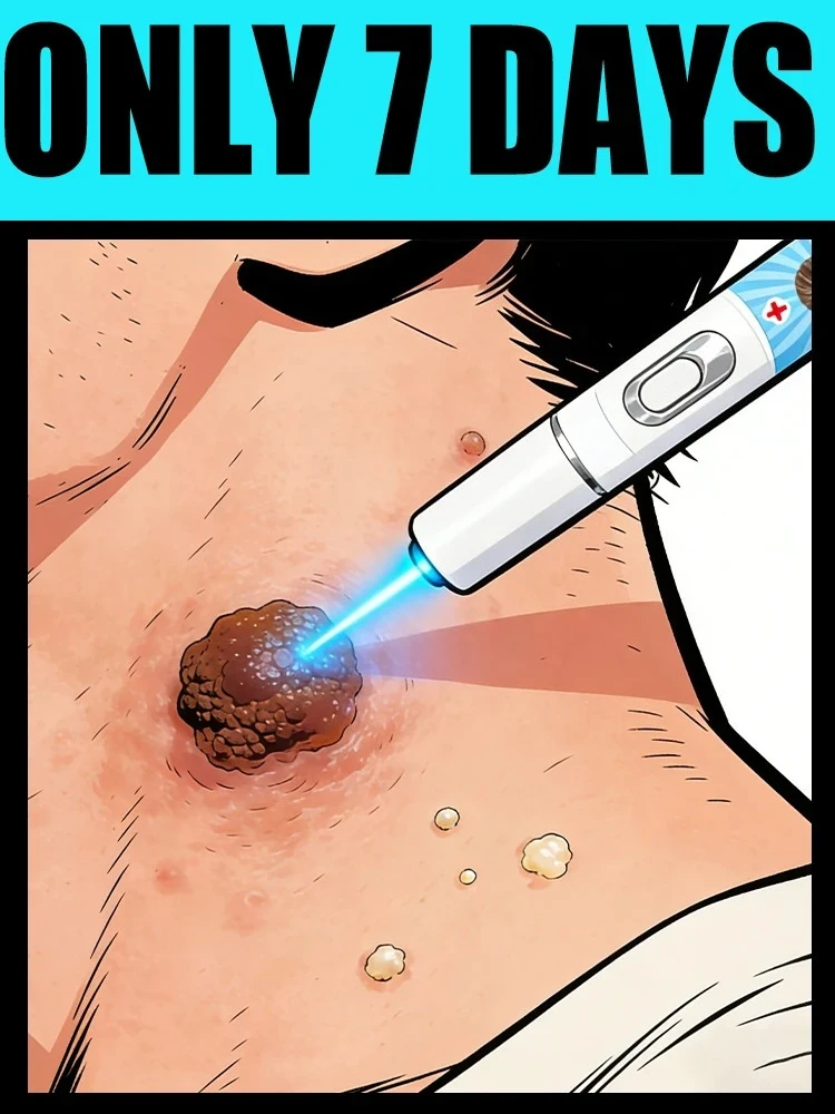 빠른 효과 7일 가려움증 및 사마귀 제거 펜 (얼굴, 손, 발용)