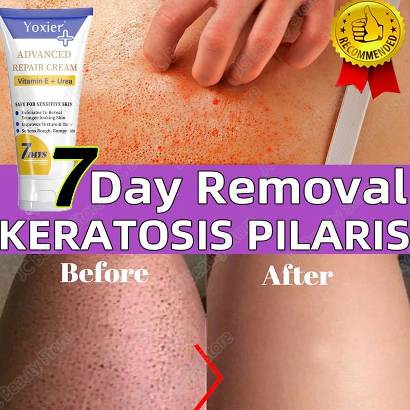 

Curing Keratosis Pilaris Repair Cream Chicken Follicle Skin Body Scrub Brighten Dark Spots Remove Smooth Moisturize Skin Care