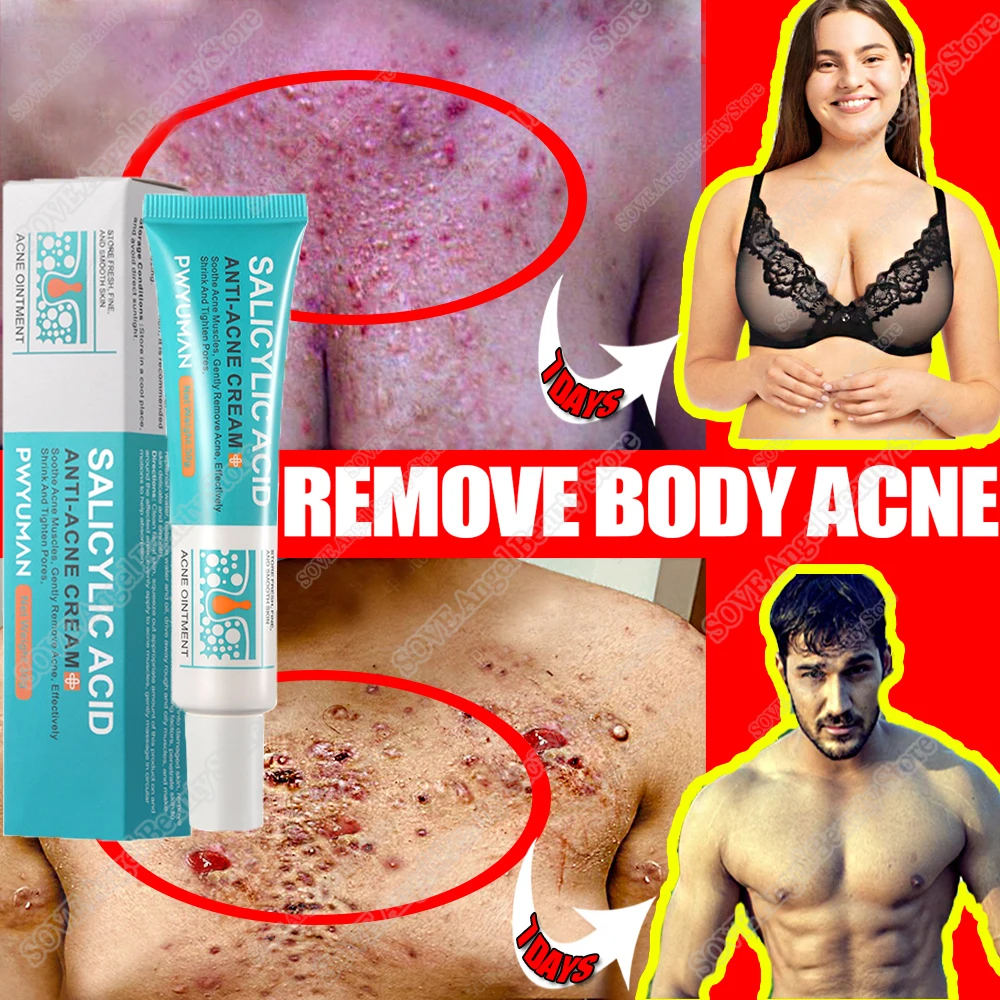 

Salicylic Acid Acne Removal Cream Effective Acne Treatment Repair Spots Scar Serum Moisturize Oil Control Shrink Pore Skin Care