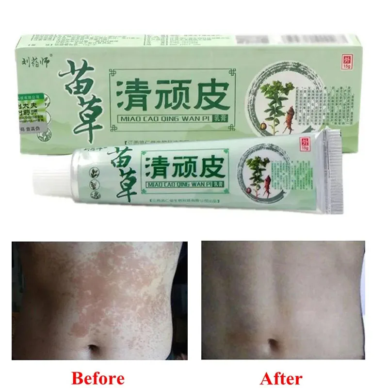 

Health psoriasis treatment cream Skin care Dermatitis Eczematoid Eczema Ointment eczema cream psoriasis Itching relief Ointment