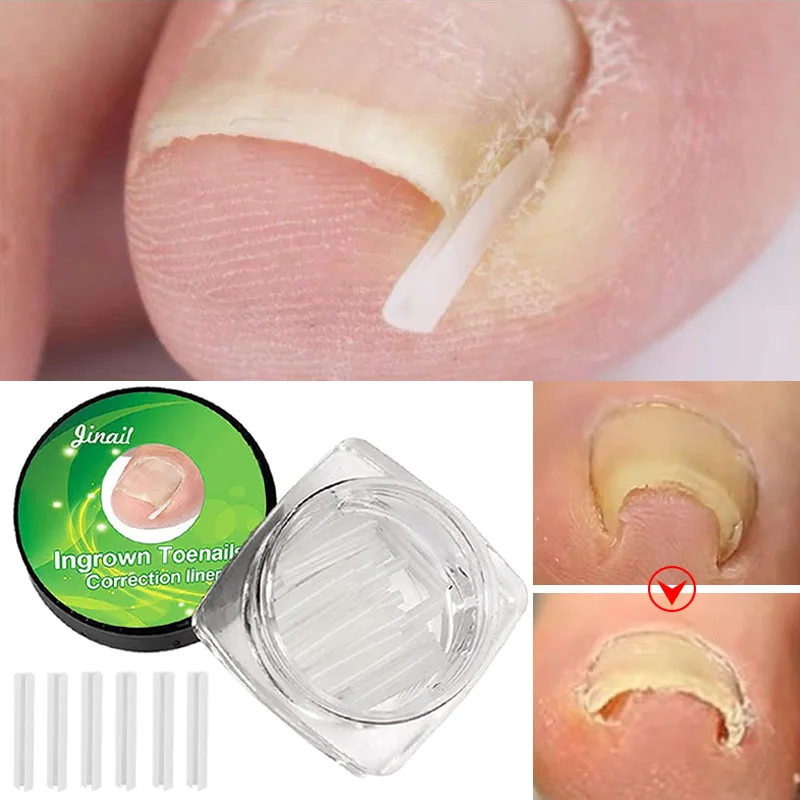 

10Pcs/Box Ingrown Toenail Correction Tool Invisible Ingrown Toe Nail Treatment Elastic Straightening Clip Brace Pedicure Tools