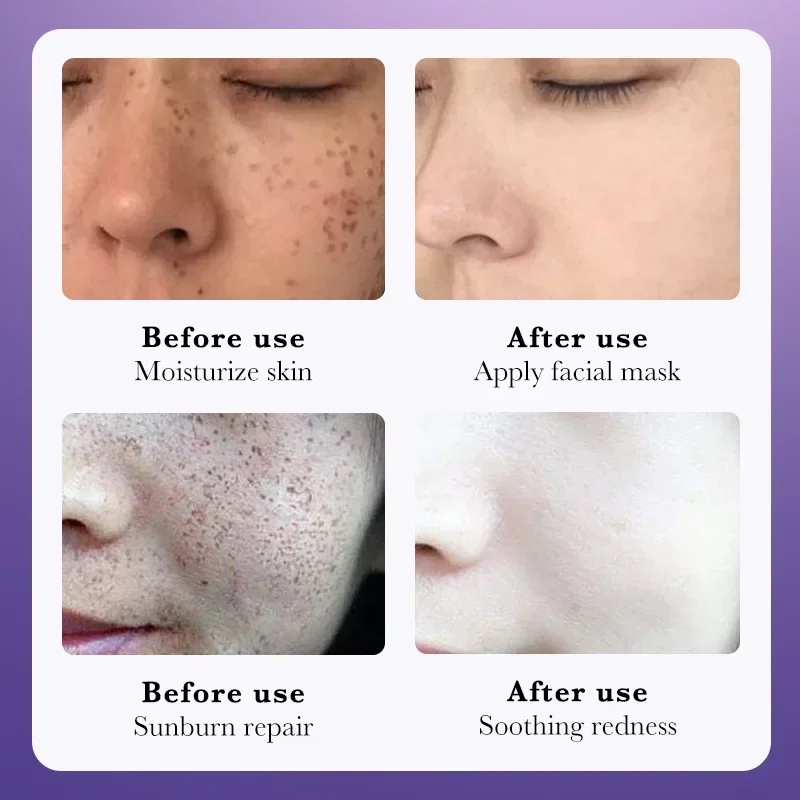 Niacinamide Whitening Freckle Cream face Remove Dark Spots Melanin Melasma Moisturizing Fading Stain facial skin care Anti-Aging