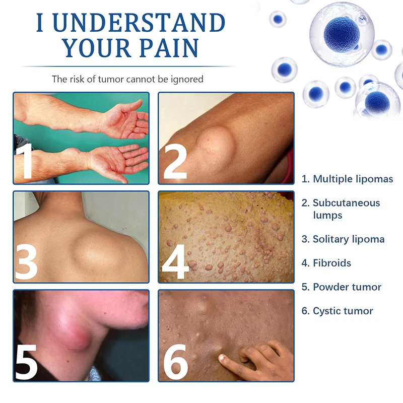 Lipoma Removal Cream 12pcs/20g Antitumor Remove Fat Lump Ointment Nodular Discomfort Skin Cyst Swelling Pain Relief Plaster