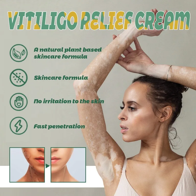 Effectively Remove Vitiligo Ointment Natural Repair Remove Ringworm White Spot Removal Skin Vitiligo Eliminate Skin Care 20g vitiligo ointment