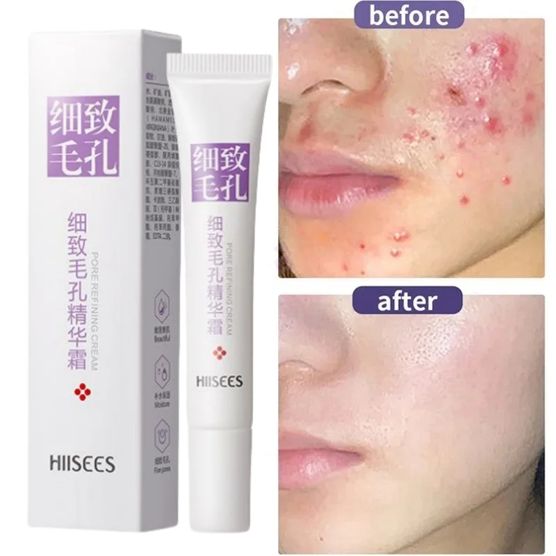 

Salicylic Acid Pore Shrinking Cream Quick Elimination Large Pores Remove Blackehead Tighten Face Smooth Skin Korean Care Product