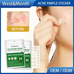 24/36/144 Pcs Acne Pimple Patch Invisible Breathable Acne Pimple Stickers Waterproof Skin Smooth Acne Pits Facial Mask Skin Care