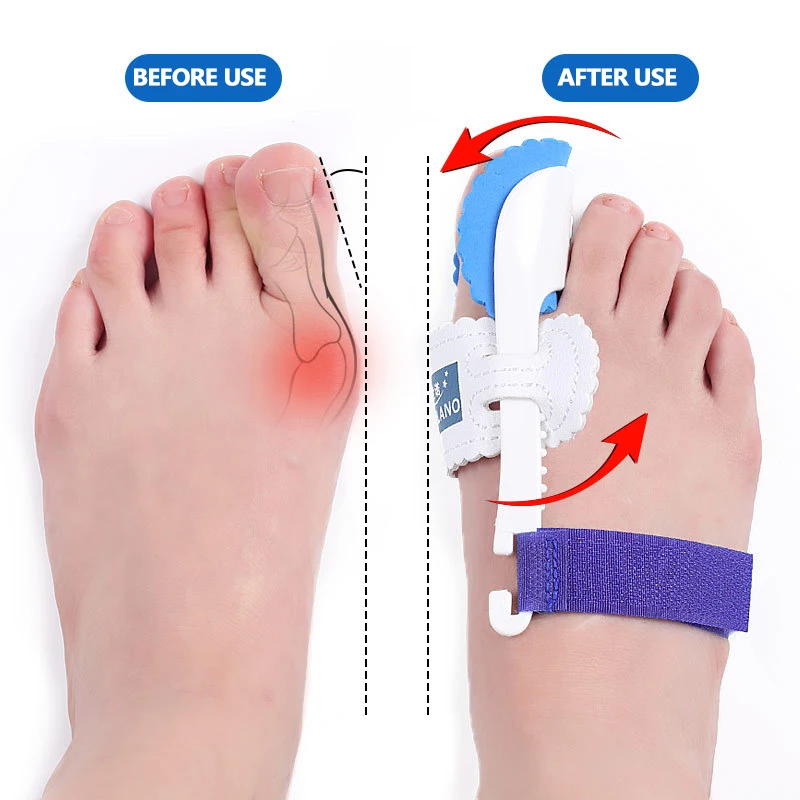 

Big Bone Thumb Toe Bunion Splint Straightener Corrector Foot Pain Relief Hallux Valgus Toe Separator Protector Foot Care Tools