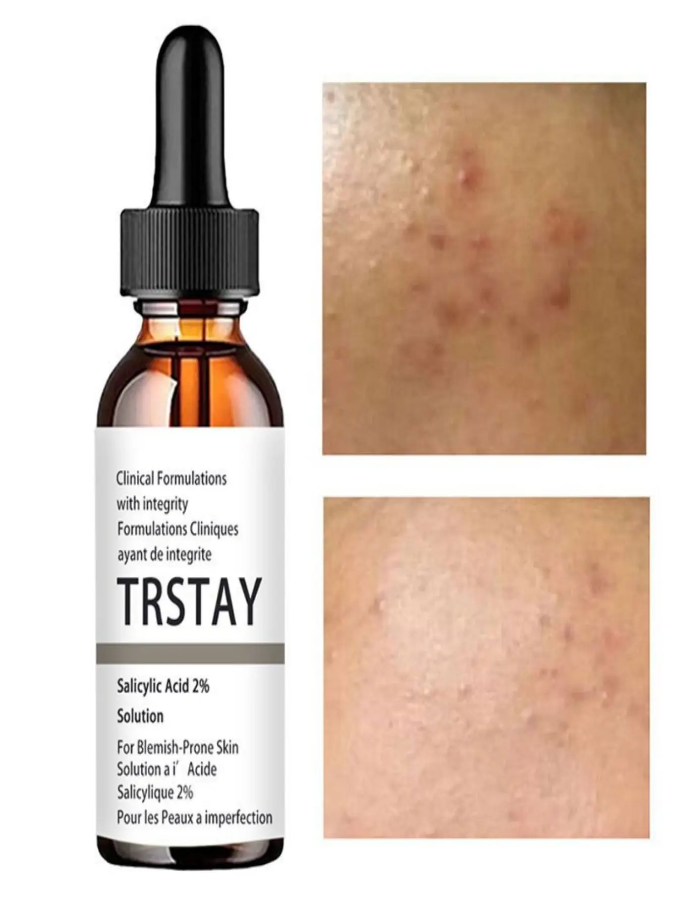 Salicylic Acid Facial Serum Facial Serum Facial Essence Salicylic Acid 2% Solution Essence Acne Spot Removing Shrink Pores Oil-Control Brighten Face Skin vitamin c serum for face