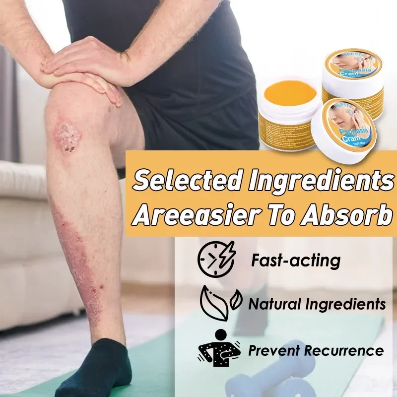 Herbal Anti-itch Psoriasis Treatment Ointment Eczema Hand Foot Tinea Against Fungi Itching Dermatitis Skin antipruritic Cream