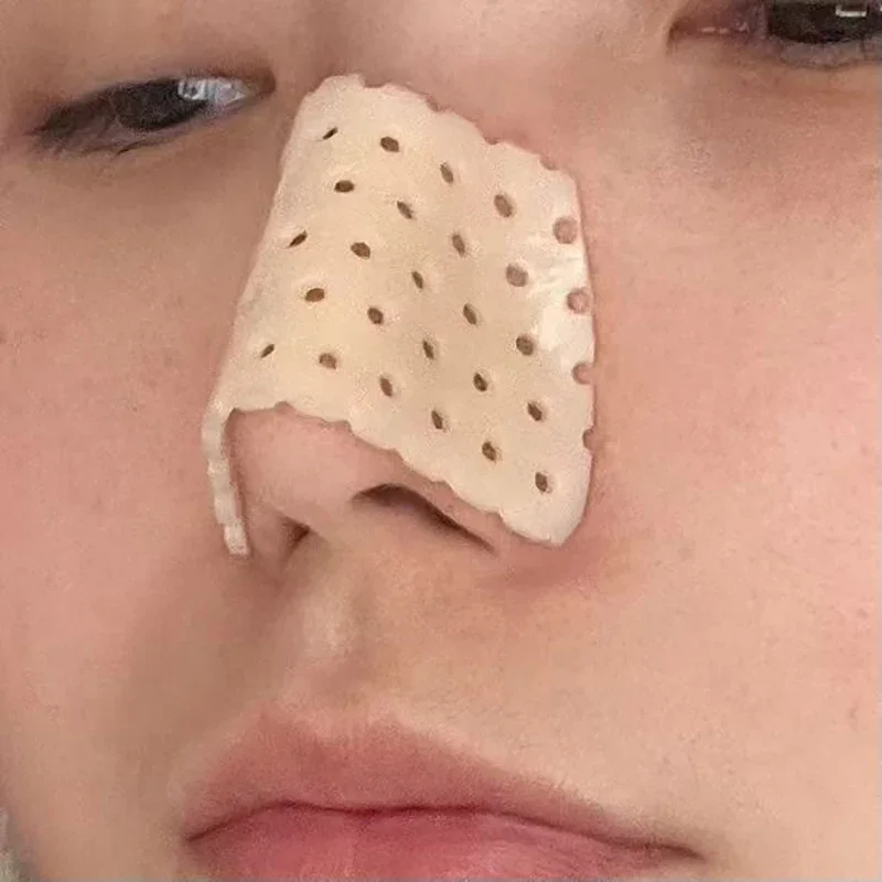 Thermoplastic Nasal Splint for Nose Fracture Correction and Support