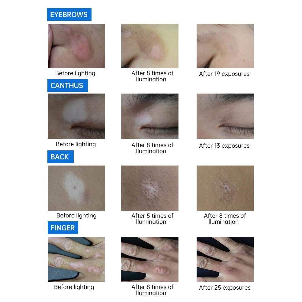 311nm UVB Treatment Instrument Vitiligo Psoriasis Skin Treatment Device Light Narrow Band Ultraviolet Phototherapy Instrument