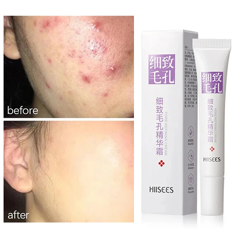 

Salicylic Acid Pore Shrinking Cream Quick Elimination Large Pores Remove Black Moisturizing Tighten Face Korean Care Product