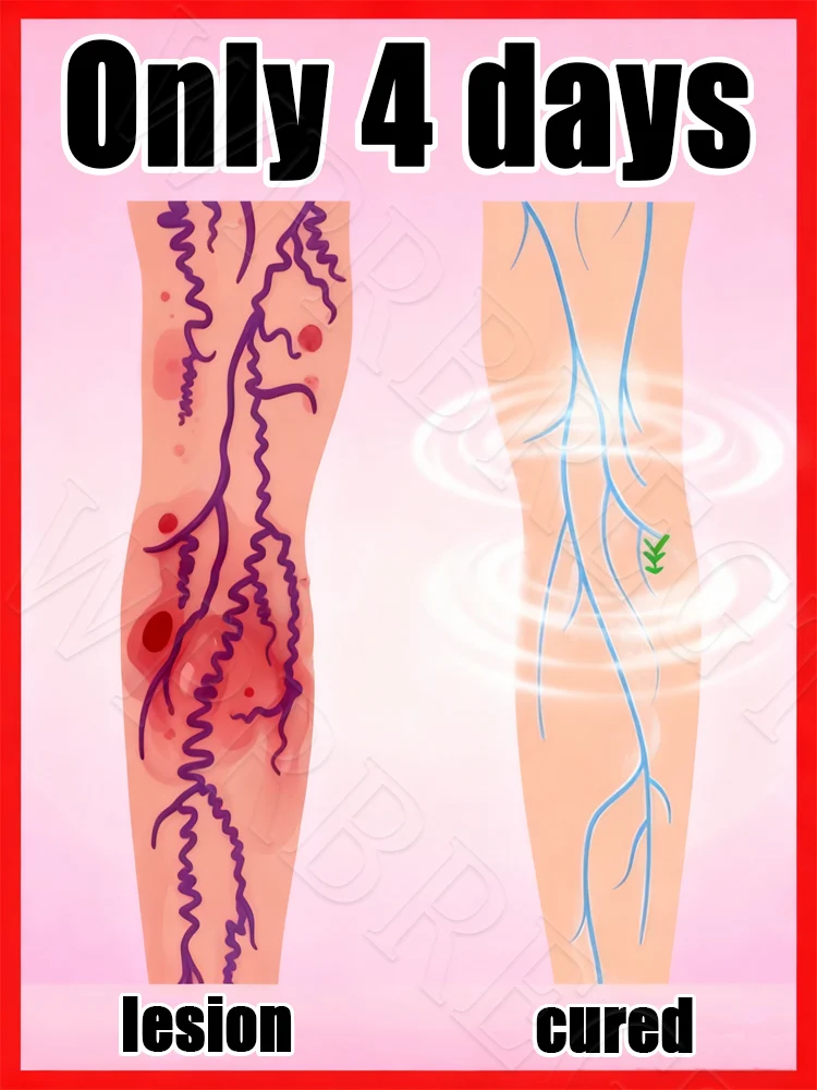 استعادة الأوردة تحت الجلد الصحية بسرعة