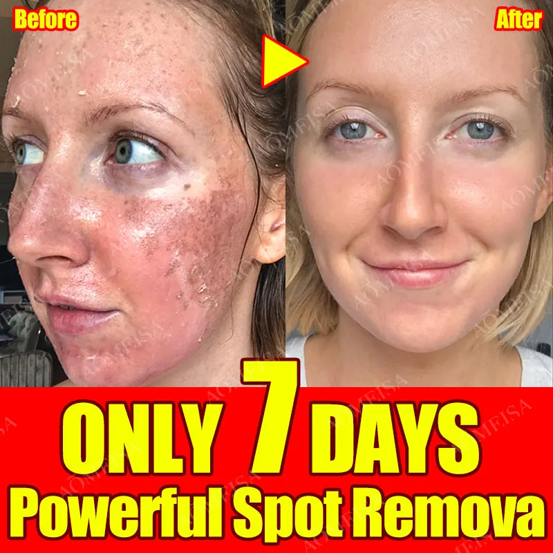 Freckles Removal Essence Remove Facial Spots Skin Dark Spot Remove