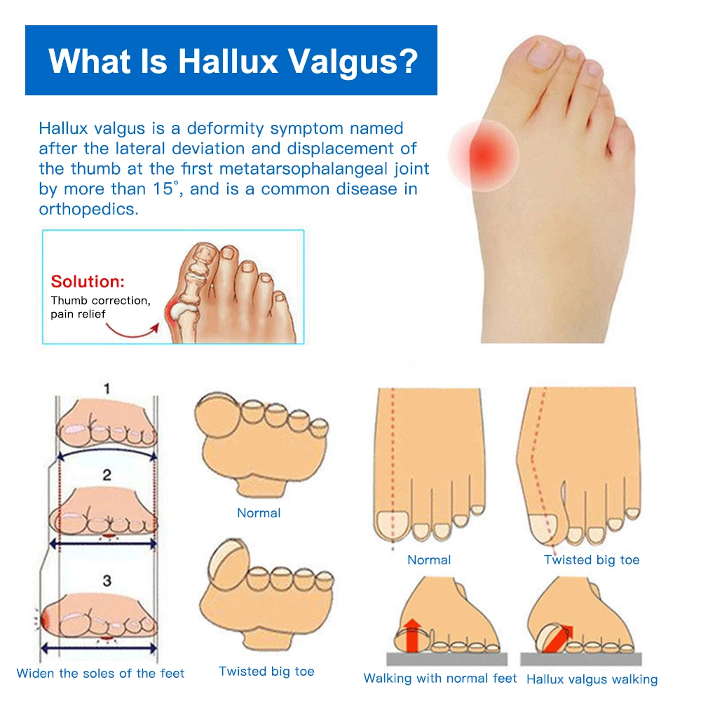 Hallux Valgus Corrector Bunion Toe Separator Gel Toe Straightener Spacer Silicone Corrector Foot Finger Separator Foot Care Tool