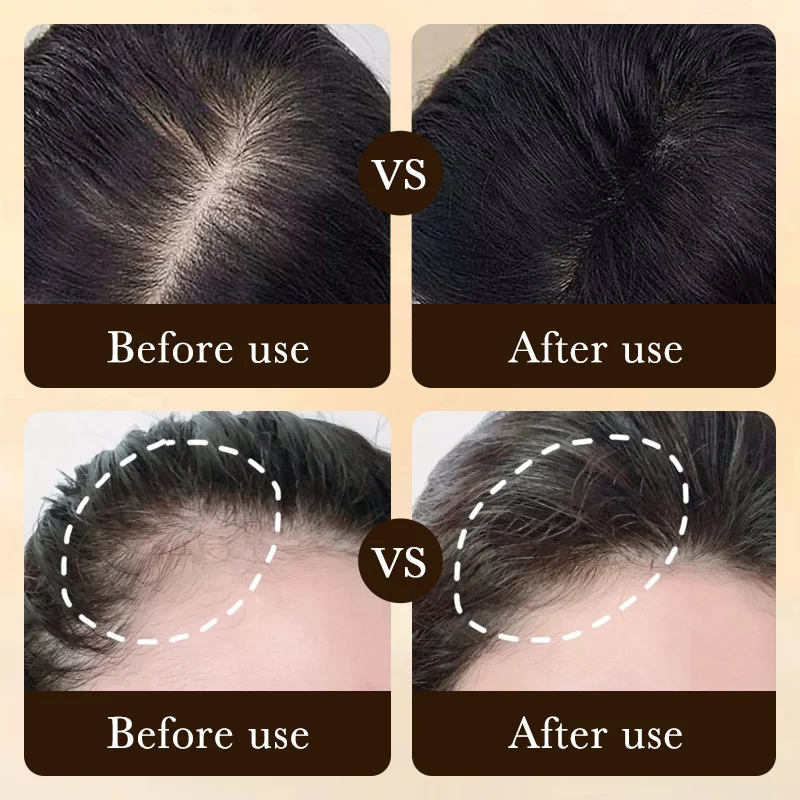 Prodotti per la crescita dei capelli Massaggio per capelli a crescita rapida Olio essenziale Anti perdita di capelli naturale Previene la secchezza dei capelli crespi danneggiati_voghion.com