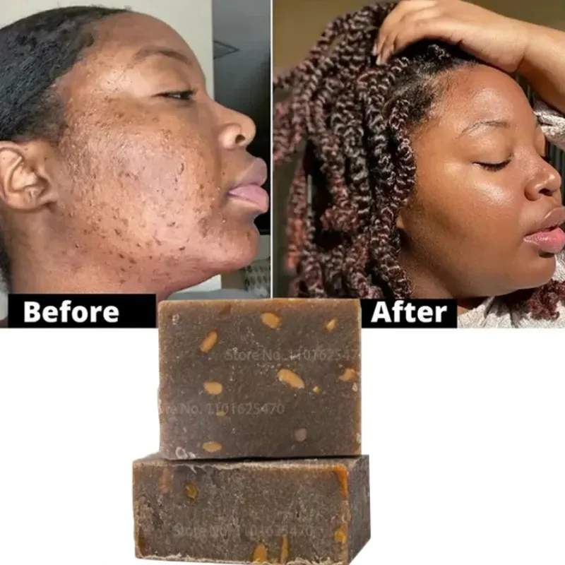 

African Black Soap Dark Spots Remover Acne Remover Anti-aging Beauty Natural Bath Body Treatment Acne Whitening Skin Care