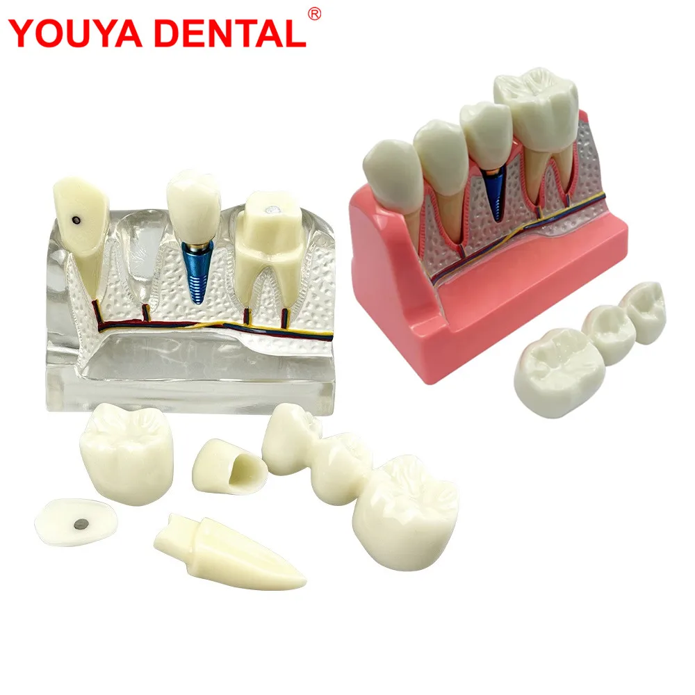 4배 확대 치과 임플란트 모델 탈착식 치아 치과 교육용 브릿지 크라운 연구용 치..
