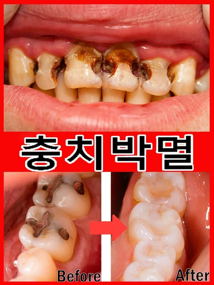 Teeth Health Product Anti Decay Toothpaste Dental Caries Repair Cream Prevent Tooth Decay Protect Teeth 30g