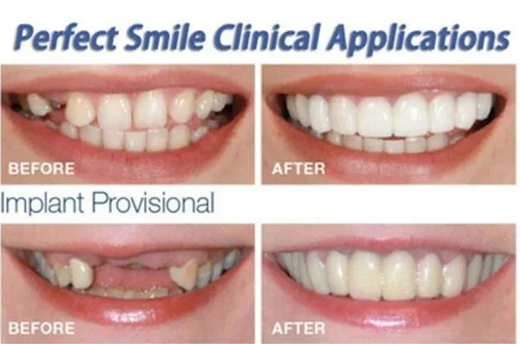 Simulation Braces Mamum Instant Smile Comfort Fit Flex Cosmetic Teeth Denture Teeth Top Cosmetic Veneer 3 set = 6 pieces