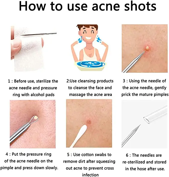 5 PCS Blackhead Remover Comedones Extractor Acne Removal Kit for Blemish, Whiteh