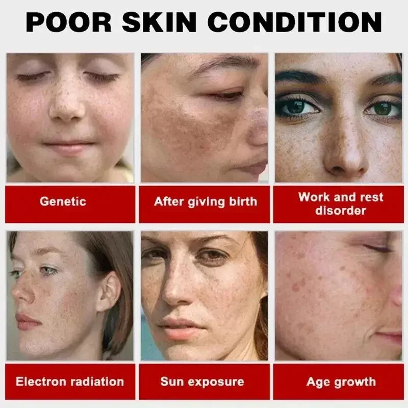 Description Picture 6 of itemWhitening Freckles Face Cream Removal Melasma Dark Spots Corrector Lighten Melanin Pigmentation Brighten Anti-Aging Beauty Care
