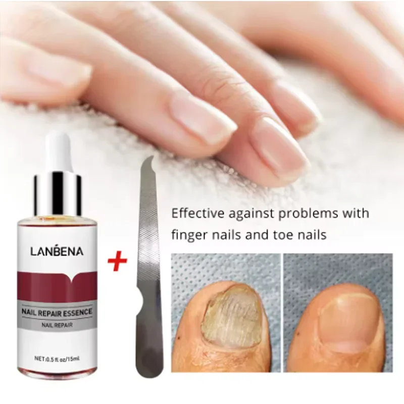 15mlFungus Care Remove Onychomycosis Toes Nourish Brighten Hands Feet Product Repair Suitable Women Nail Pepair Essencs