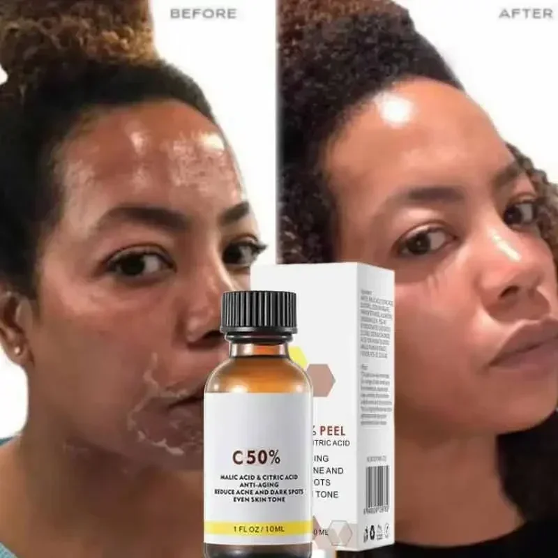 Face Care Exfoliating Peeling Oil Chemical Peel Pigmentation Lightening Melanin Acne Treatment Remove Scar Yellow Peeling Oil