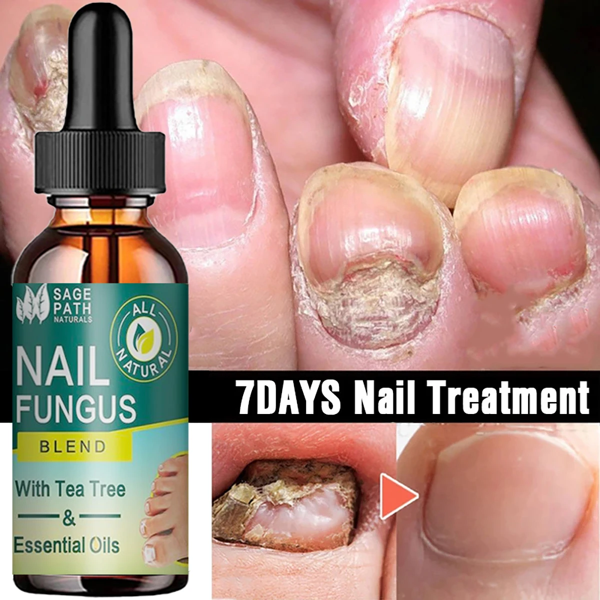 7DAYS Repair Nail Fungus Treatments Essence Foot Care Serum Toe Nails Fungal Removal Gel Anti-Infection nail care essence