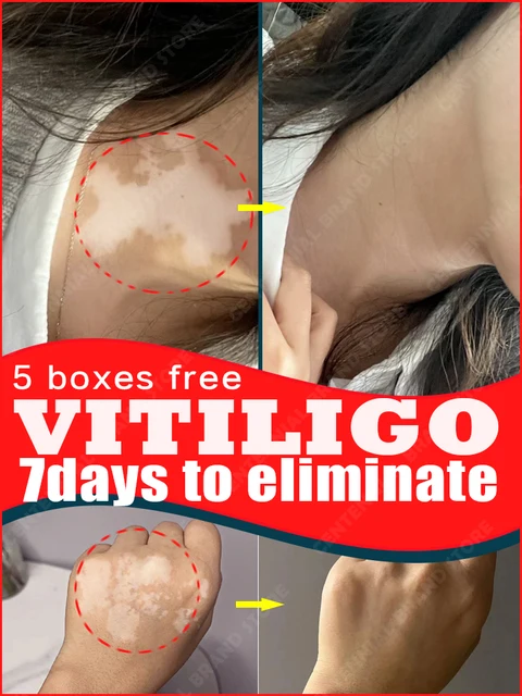 Vitiligo Repair Cream: Effective Solution for White Spot Elimination