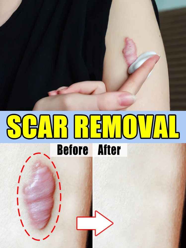 ᴴᵉᵃˡ ˢᶜᵃʳˢ ⁱⁿ ⁷ ᵈᵃʸˢ scar treatment
