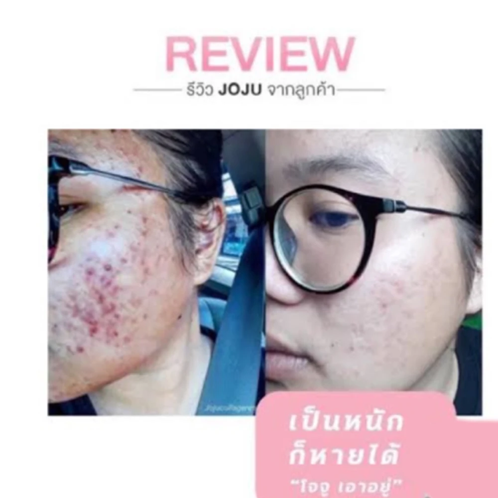 3X JOJU Collagen Dipeptide Reduce Acne Dark Spots Freckles oil control Smooth Lightening Whiten and brighten Younger Skin Care