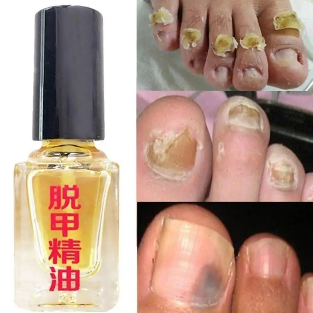 3 Days Effect Fungus Removal Liquid Fungal Nail Treatment Bright Nail