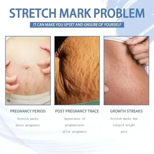 44716-1f81ee.jpg Stretch Mark Repair Cream – Firm, Smooth & Restore Skin
