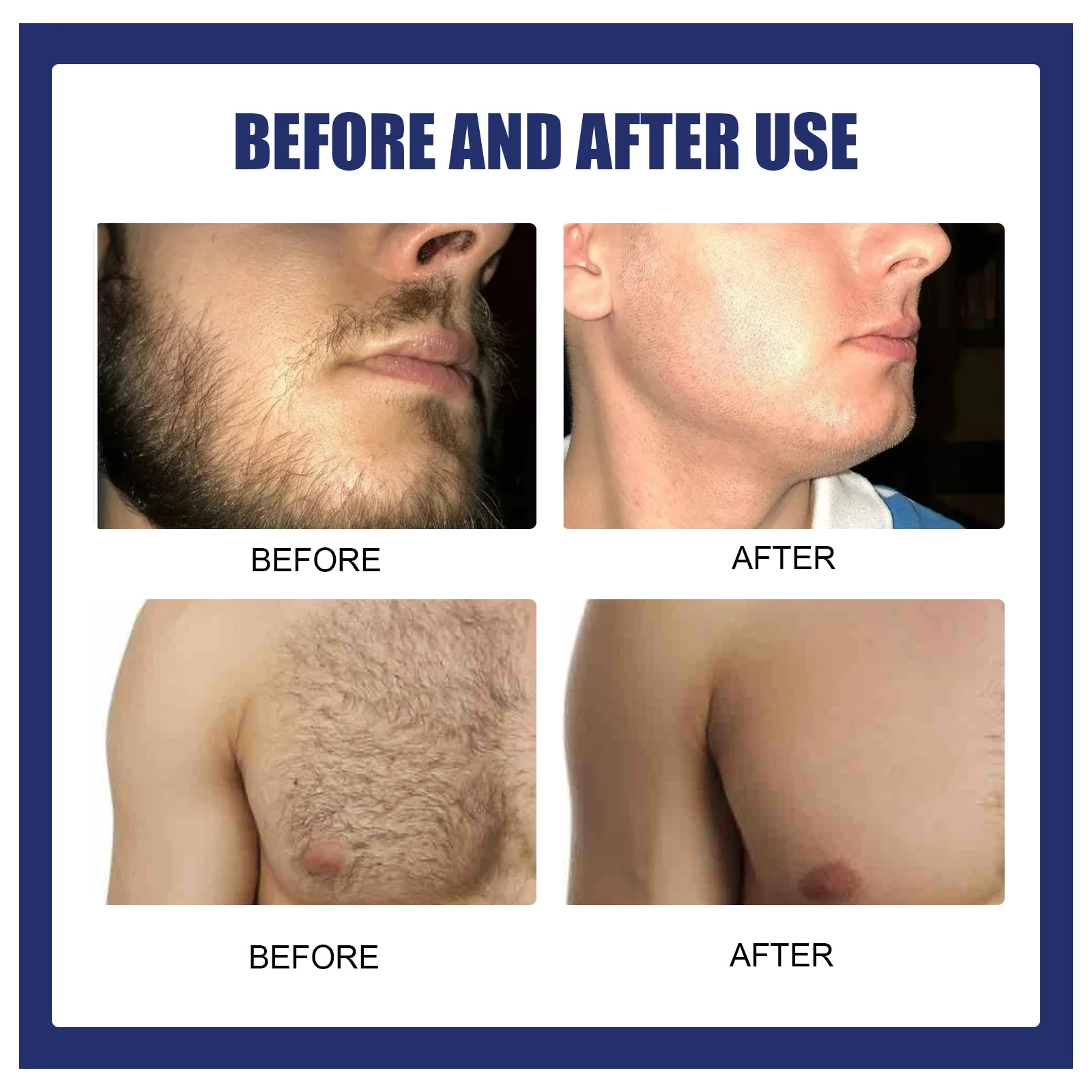 Aggregate more than 156 permanent chest hair removal latest
