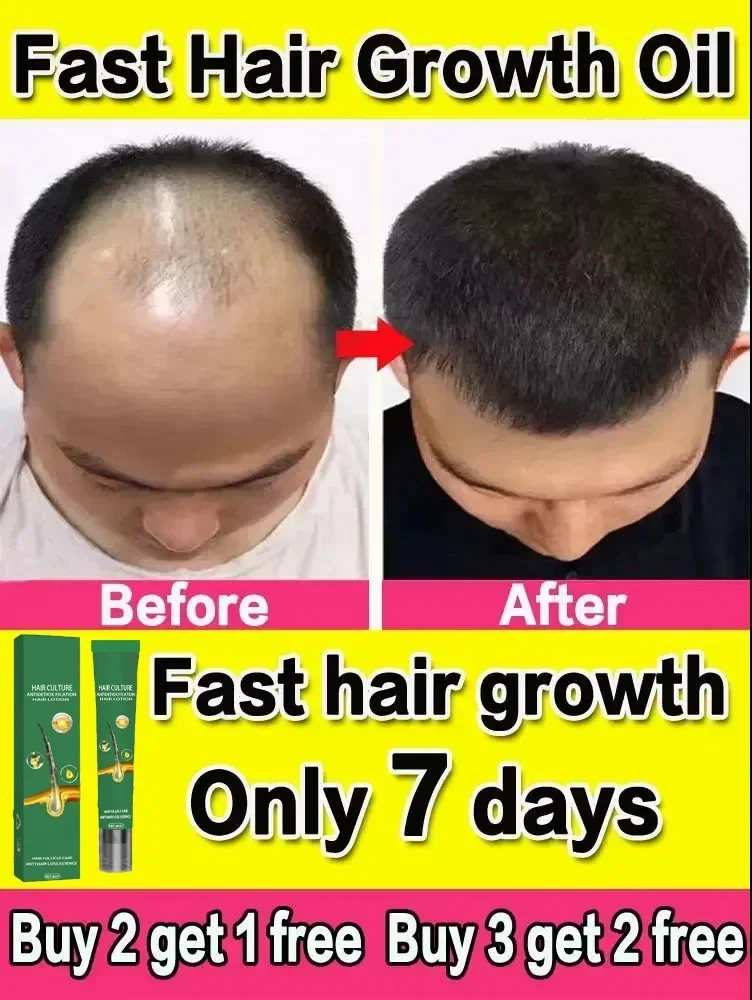 Successful products, 99% of buyers will buy again, they have more and more hair, say alpha baldness, thick hair