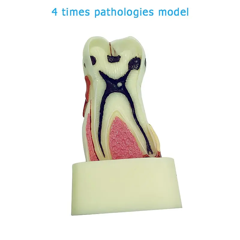 

Dental Model 4 Times Pathologies Model Teeth Model Dentist Studying and Researching Dentistry Supplies