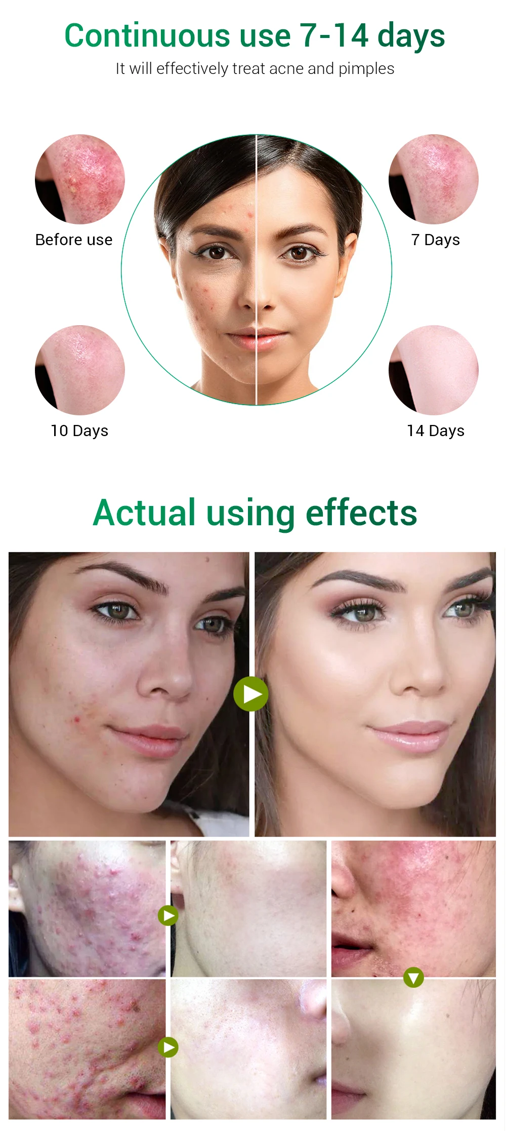 best acne treatment