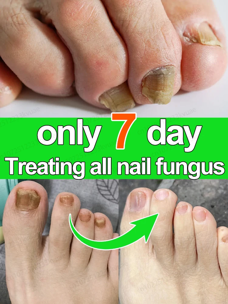 Nail fungus treatment essential oil repair onychomycosis in 7 days fungus solution,organic essential oil
