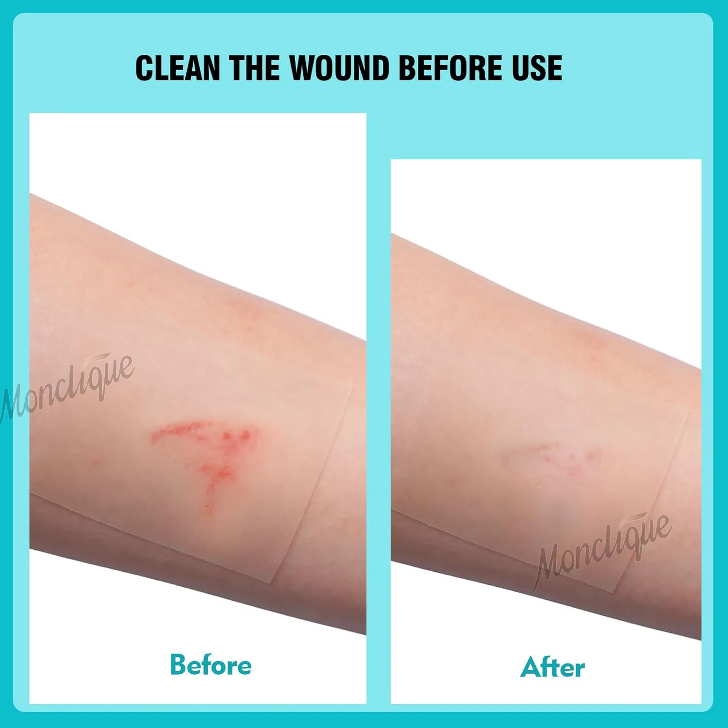 Hydrocolloid Patch Bandages Self-Adhesive Medical-Grade Bed Sore Bandages Acne Care Sterile and Waterproof First Aid Care Tool